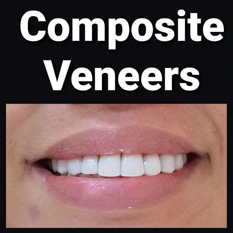 veneers